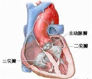 老年人黏液性瓣膜病