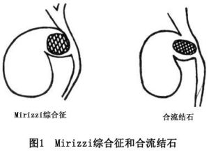 膽石病