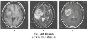 膠質母細胞瘤