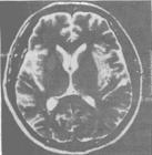 單純皰疹病毒性腦炎