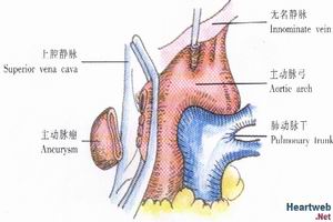 胸主動脈瘤