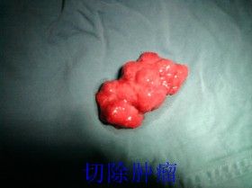 腸巨大絨毛狀腺瘤