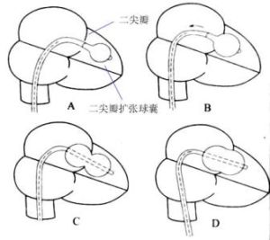 經皮球囊二尖瓣成形術