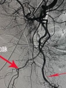 陰莖異常勃起