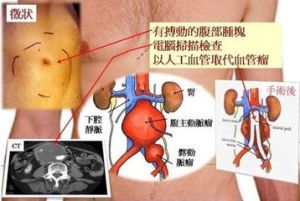 感染性腹主動脈瘤