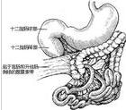 先天性腸旋轉不全整復術