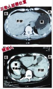 鏡面人內臟圖像