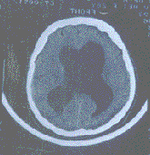 梗阻性腦積水