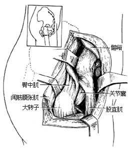 髖關節結核