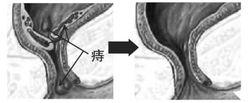 痔瘡核