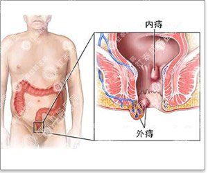 血栓外痔