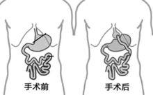 胃旁路手術原理