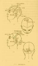 常用頭皮針刺激部點陣圖