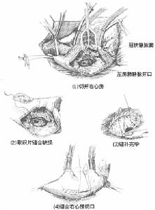 妊娠合併心房間隔缺損