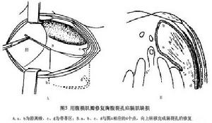 先天性胸骨旁疝