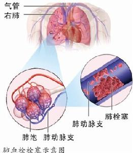 肺血栓栓塞