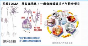 SOMA（神經元胞體）—癲癇滲透激活術圖解