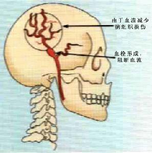 腦供血不足