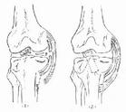 （圖）膝外側韌帶損傷