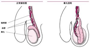 精道異常不育症