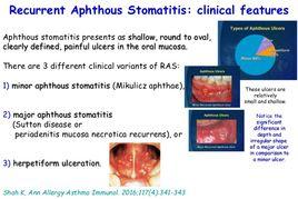 復發性阿弗他性口腔炎