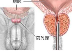 前列腺炎