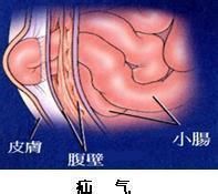 腹股溝直疝