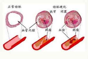 Thrombus