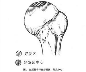 急性減壓性骨壞死