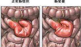 謝爾舍米斯基病症