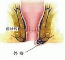 肛門指診