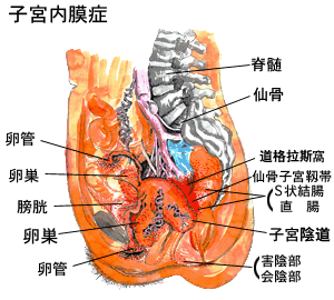 慢性子宮內膜炎