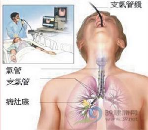 纖維支氣管鏡檢查