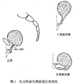 絕經期尿失禁