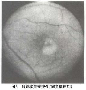 卵黃狀黃斑營養不良
