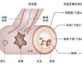 神經性腸梗阻綜合徵