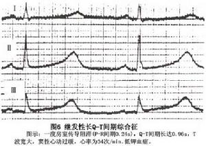 間歇依賴型尖端扭轉型室性心動過速