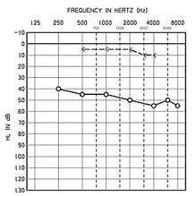 傳導性聽力損失的示意聽力圖
