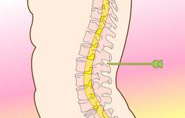 頸椎脊髓損傷