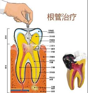 根管治療物理結構示意圖