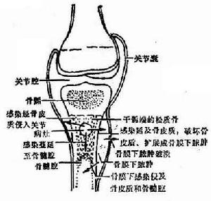 硬化性骨髓炎