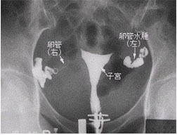 輸卵管積水