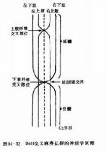 脊髓前動脈綜合症