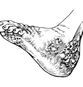 足分支菌病