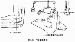 骨折洗方