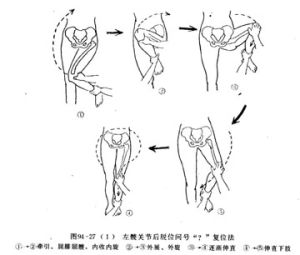 髖關節後脫位