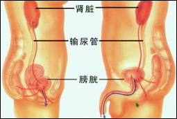 膜增生性腎小球腎炎