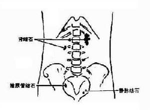 腎盂積水