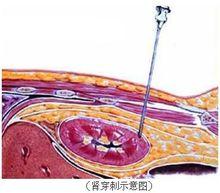 腎臟穿刺術