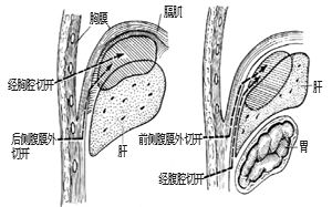 膈下膿腫